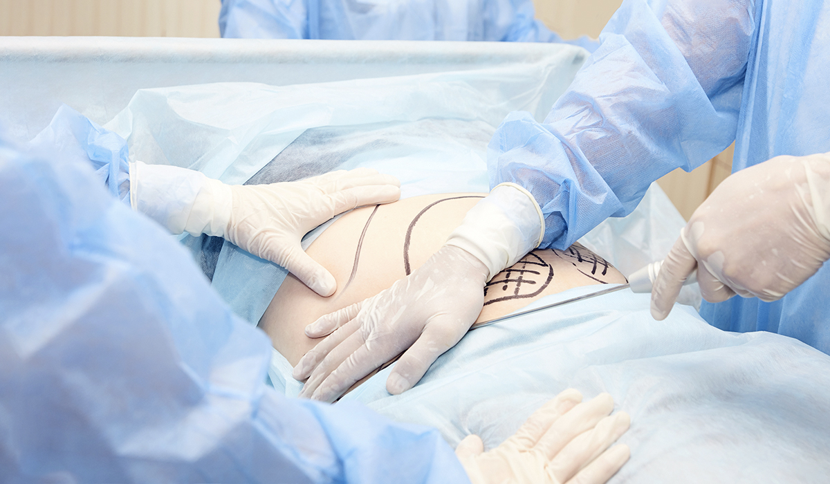 The Procedure For An Outpatient Liposuction Procedure Is