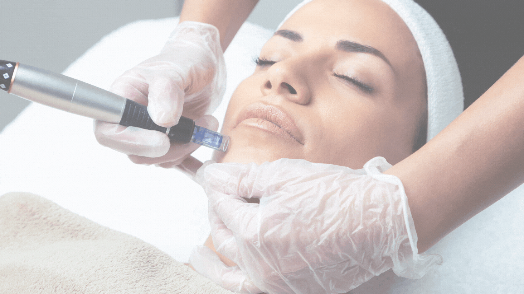 Buglino LP april 2024 (1) Best Microneedling on Long Island